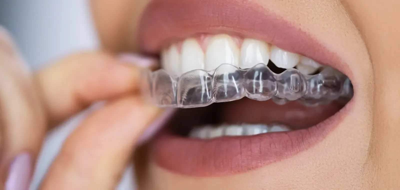 Aligneurs transparents Invisalign White & Care Anderlecht