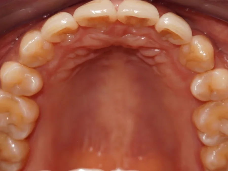 Après traitement orthodontique à Anderlecht : dents encombrées réalignées