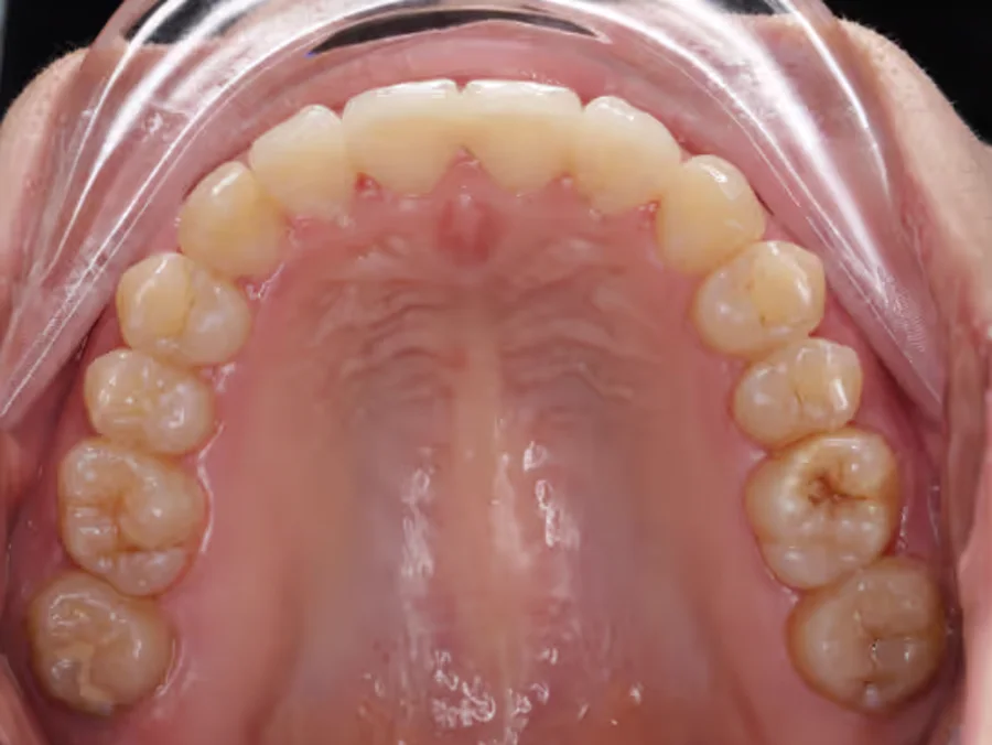 Après traitement orthodontique à Anderlecht : encombrement corrigé et contention posée