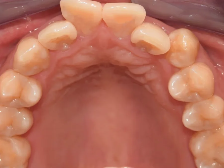 Avant traitement orthodontique à Anderlecht : dents encombrées réalignées