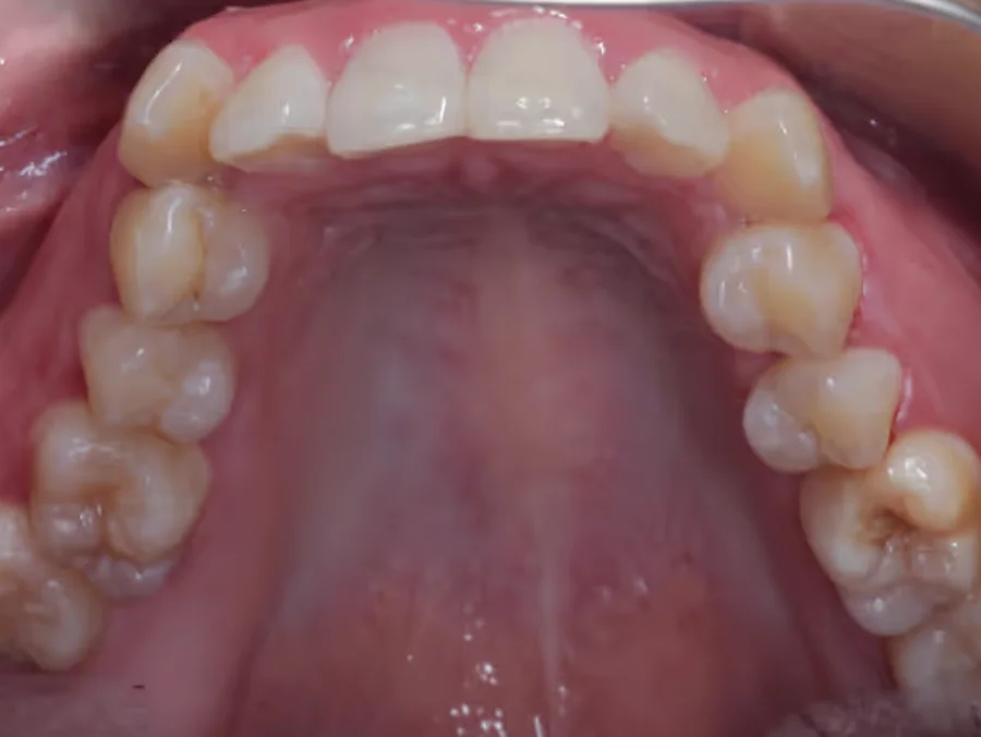 Avant traitement orthodontique à Anderlecht : encombrement corrigé et contention posée